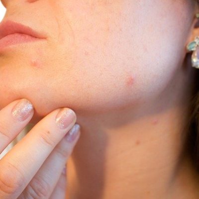 ニキビ占いは当たる⁈思い思われ振り振られニキビの場所でどんな意味がある？ アイキャッチ画像